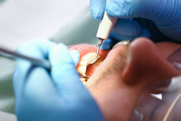 Best Emergency Wisdom Teeth Removal in Walkersville, MD